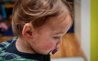 The measles rash is made up of small red-brown spots that may join together into larger blotchy patches.